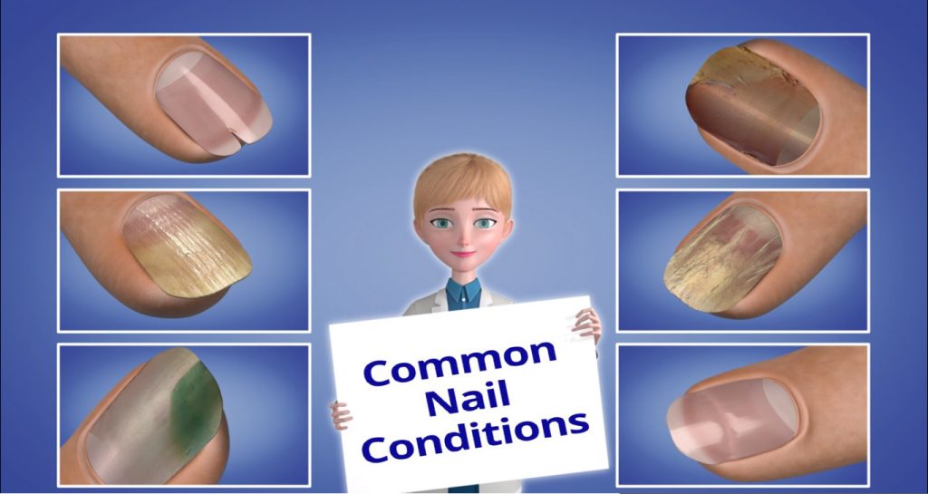 Nail Conditions