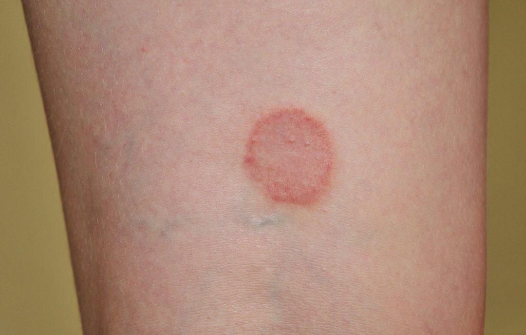 Ringworm, dermatophyte infection on skin